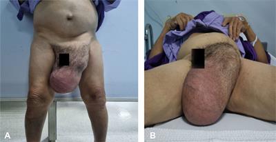 Giant paratesticular dedifferentiated liposarcoma with intraabdominal extension: a case report